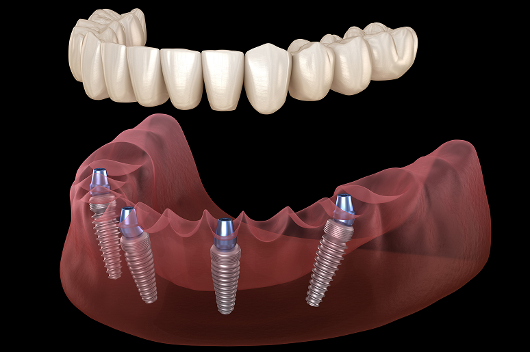 All-on-4 dental implants full arch restoration