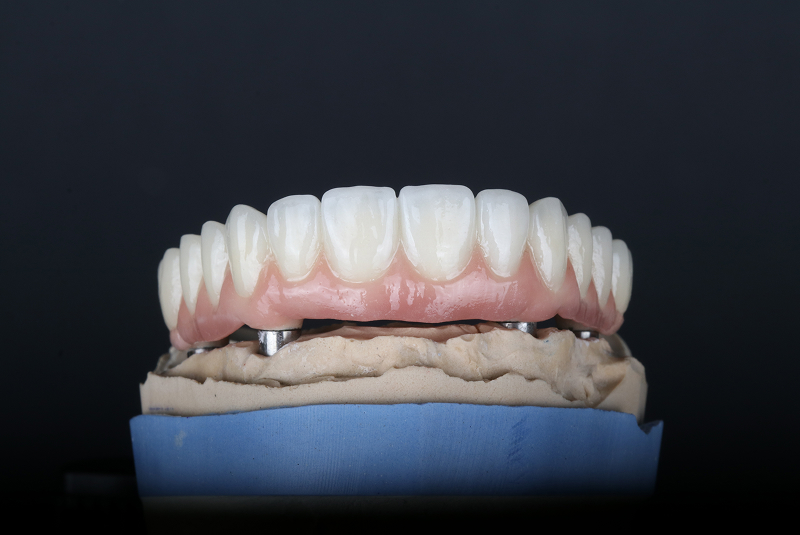 Patient candidacy evaluation for All-on-X implants