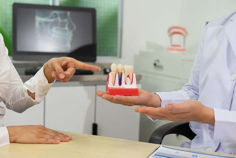 All-on-X dental implants customized full arch restoration