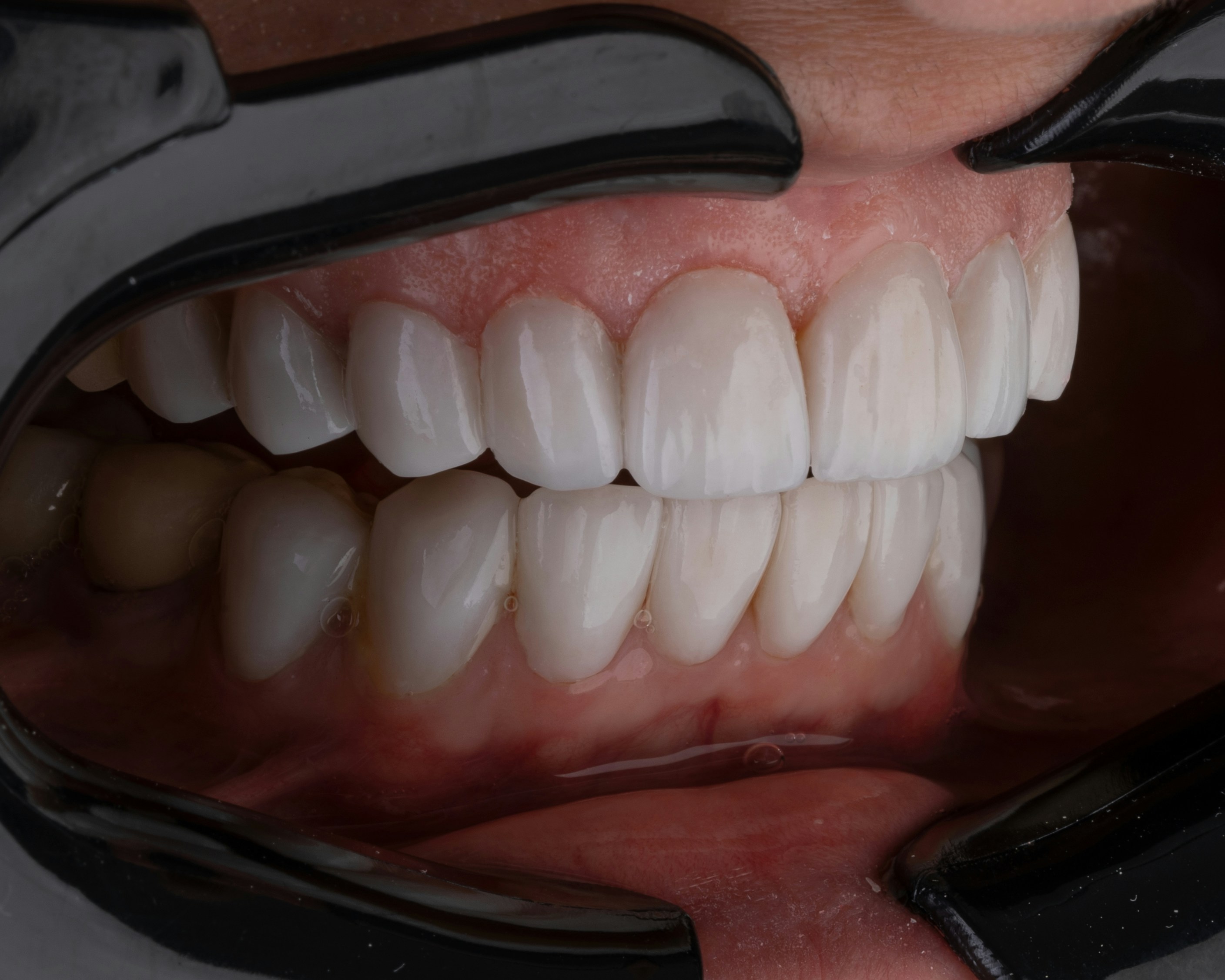 Confident patient after All-on-4 dental implant procedure