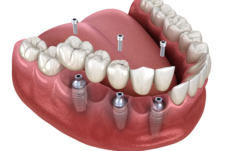 Multiple tooth dental implant bridge restoration