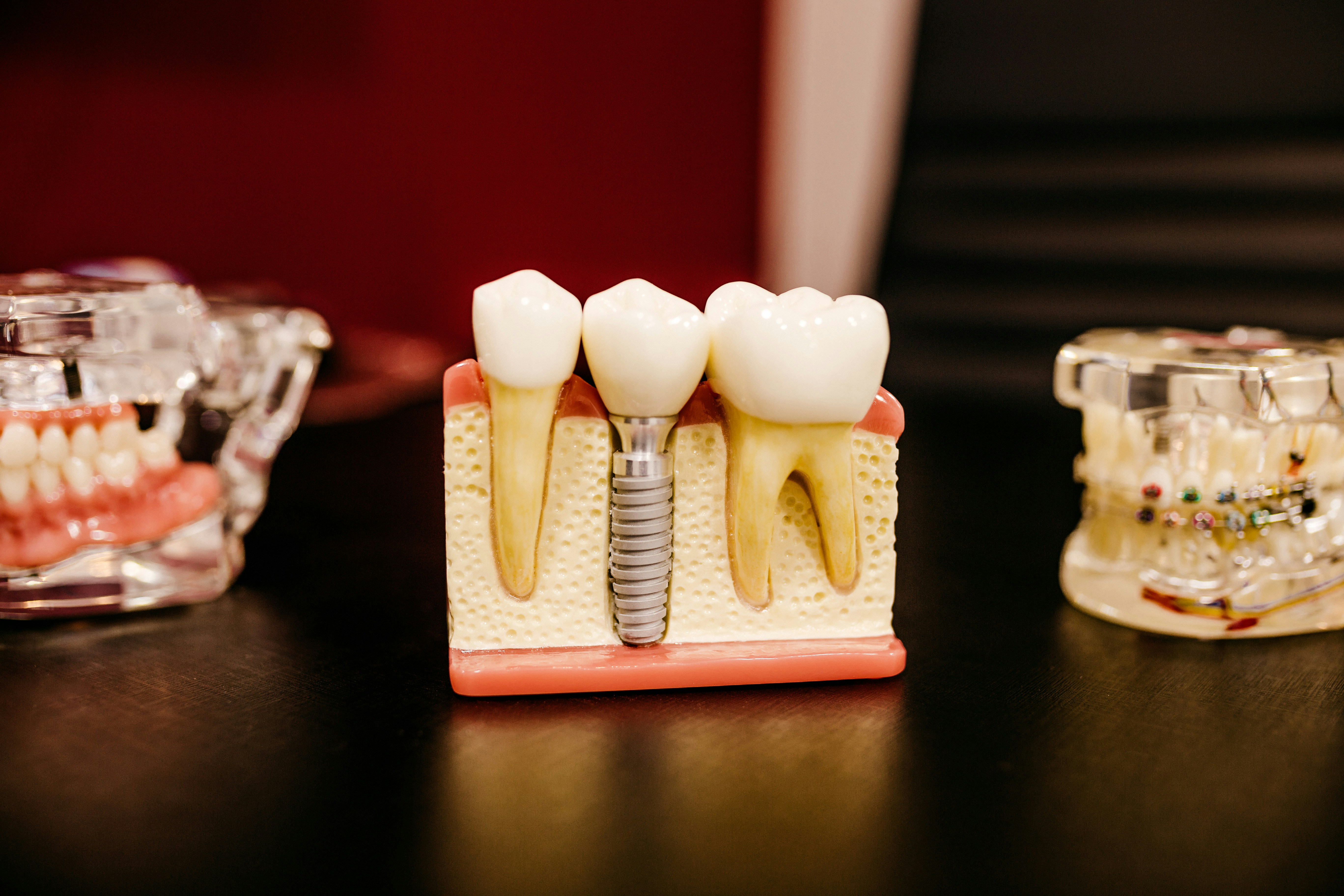 Patient smiling after single tooth implant procedure