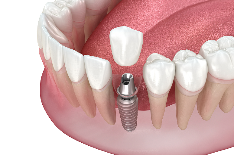 Single tooth dental implant and crown replacement