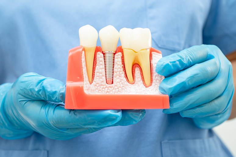 Single tooth dental implant placement procedure