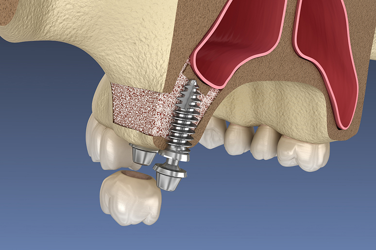 Patient who received same-day dental implant smiling confidently